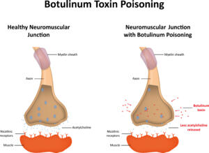 Botulismus Vergiftung